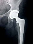 Depuy Hip Replacement Lawsuit Funding Now Available